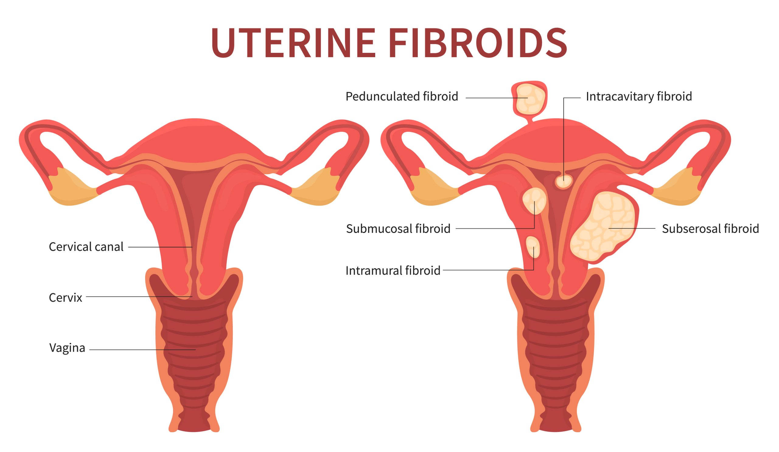 How do fibroids influence the body